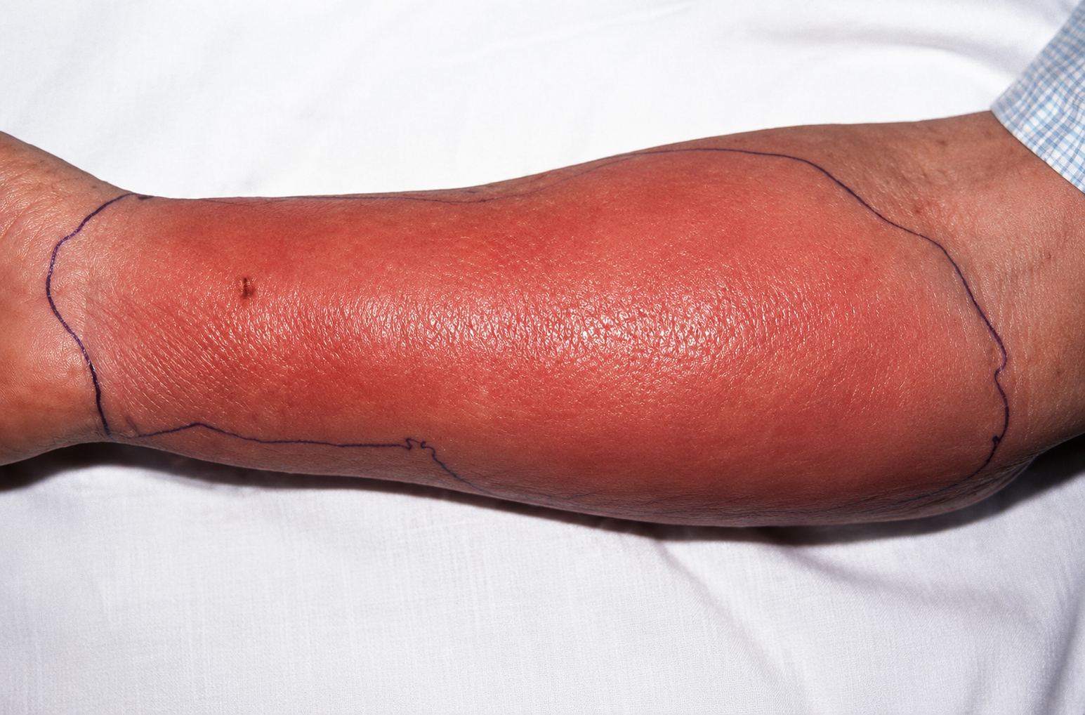 Stage 1 — early: erythema and pain